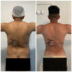 LIPOESCULTURA VASER