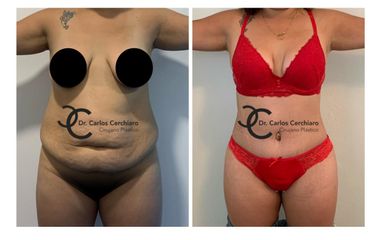 ABDOMINOPLASTIA + LIPOESCULTURA 