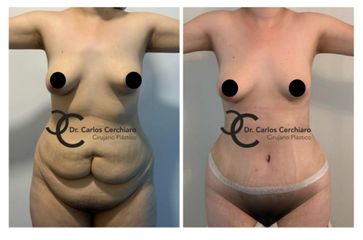 ABDOMINOPLASTIA + LIPOESCULTURA 