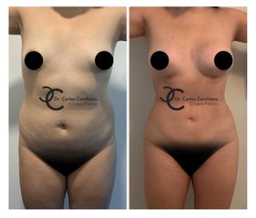 Cirugía Plástica Santiago - Lipoescultura + Implantes mamarios