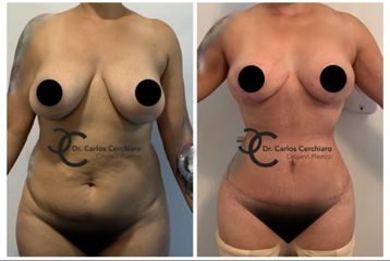 Cirugía Plástica Santiago - Lipoabdominoplastia + Mastopexia