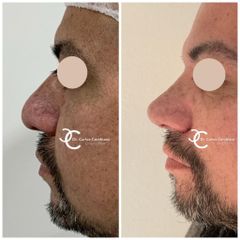 Cirugía Plástica Santiago - Rinoplastia