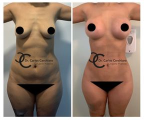 Lipoescultura Vaser + Implantes mamarios con prótesis - Cirugía Plástica Santiago