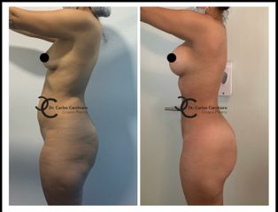 Lipoescultura Vaser + Implantes mamarios con prótesis - Cirugía Plástica Santiago