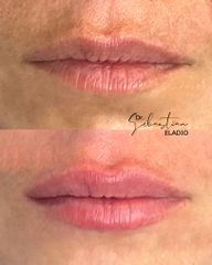 Aumento de labios - Dr. Sebastián Eladio