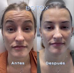 Toxina Botulínica  - Dr. Sebastián Eladio