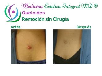 Borrar cicatrices - 626893