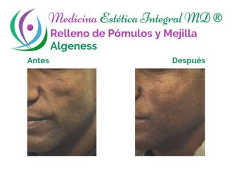 Aumento de Pómulo - 628826