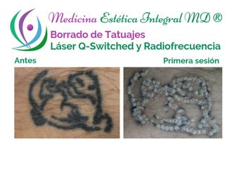 Borrar tatuajes - 629722