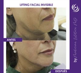 Lifting Facial Invisible - Medicina Estética Integral MD
