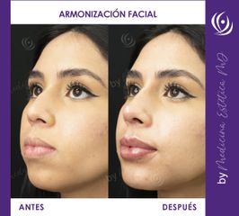 Armonización Facial - Antes y Después