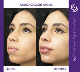 Armonización Facial - Antes y Después.jpg