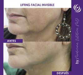Lifting Facial Invisible  - Medicina Estética Integral MD