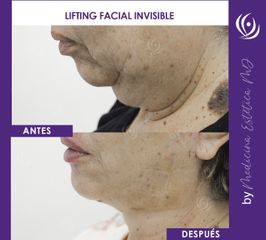 Lifting Facial Invisible  - Medicina Estética Integral MD