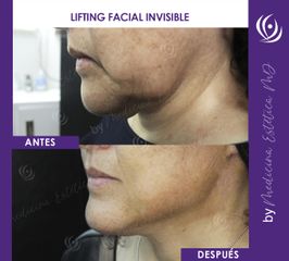 Lifting Facial Invisible  - Medicina Estética Integral MD