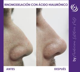 Rinomodelación con Ácido Hialurónico - Medicina Estética Integral MD