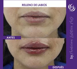 Relleno de Labios - Medicina Estética Integral MD