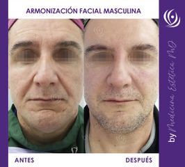 Armonización Facial MASCULINA - Medicina Estética Integral MD