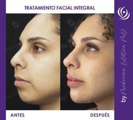 Tratamiento facial integral - Medicina Estética Integral MD