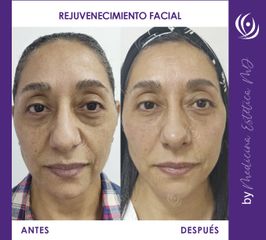 Rejuvenecimiento facial - Medicina Estética Integral MD