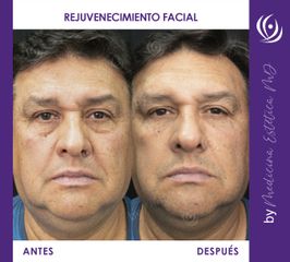 Rejuvenecimiento facial - Medicina Estética Integral MD