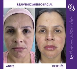 Rejuvenecimiento facial - Medicina Estética Integral MD