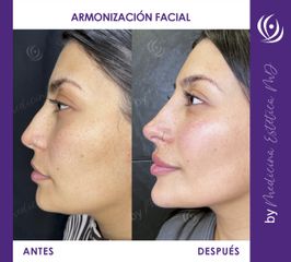 Armonización Facial - Medicina Estética Integral MD