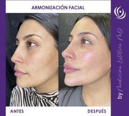 Armonización Facial - Medicina Estética Integral MD