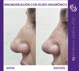 Rinomodelación y relleno delabios- Antes y Después 4.jpg