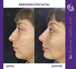 Armonización Facial - Antes y Después