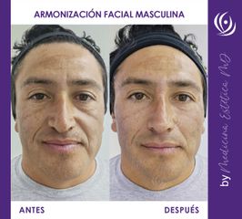 Armonización Facial MASCULINA - Antes y Después