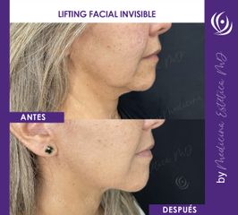 Lifting Facial Invisible - Antes y Después