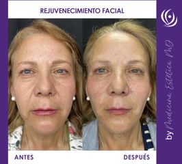 Rejuvenecimiento facial - Antes y Después