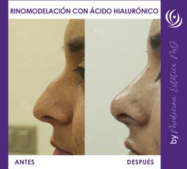 Rinomodelación con Ácido Hialurónico - Antes y Después