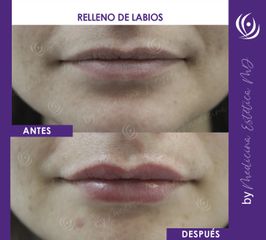 Relleno de Labios - Antes y Después
