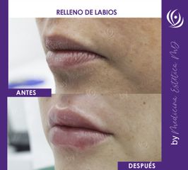 Relleno de Labios - Antes y Después