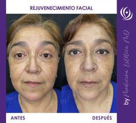 Rejuvenecimiento facial - Antes y Después
