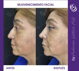 Rejuvenecimiento facial - Antes y Después