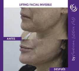 Lifting Facial Invisible  - Antes y Después