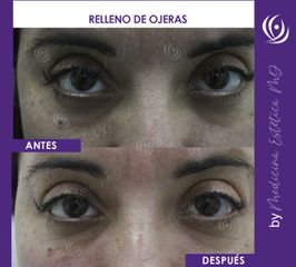 Relleno de Ojeras - Antes y Después