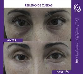 Relleno de Ojeras - Antes y Después