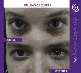 Relleno de Ojeras - Antes y Después 