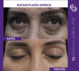 Blefaroplastia inferior - Medicina Estética Integral MD