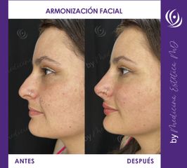 Armonización Facial - Medicina Estética Integral MD