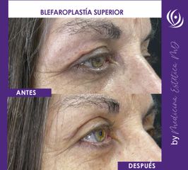 Blefaroplastia superior - Medicina Estética Integral MD