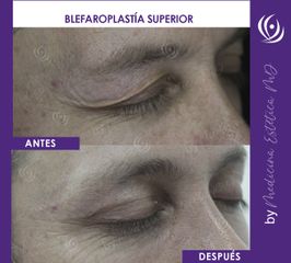 Blefaroplastia - Medicina Estética Integral MD