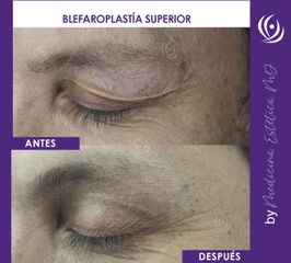 Blefaroplastia - Medicina Estética Integral MD