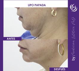 Lipo papada - Medicina Estética Integral MD