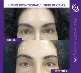 Lifting Frontociliar - Medicina Estética Integral MD