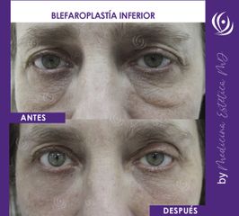 Blefaroplastia - Medicina Estética Integral MD